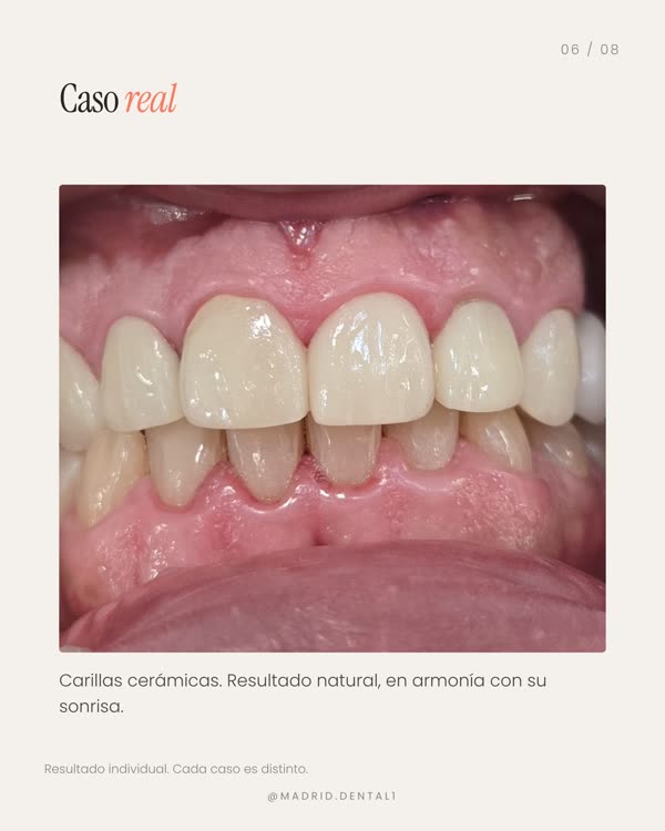 Carrusel sobre mitos de las carillas, diapositiva 6 de 8