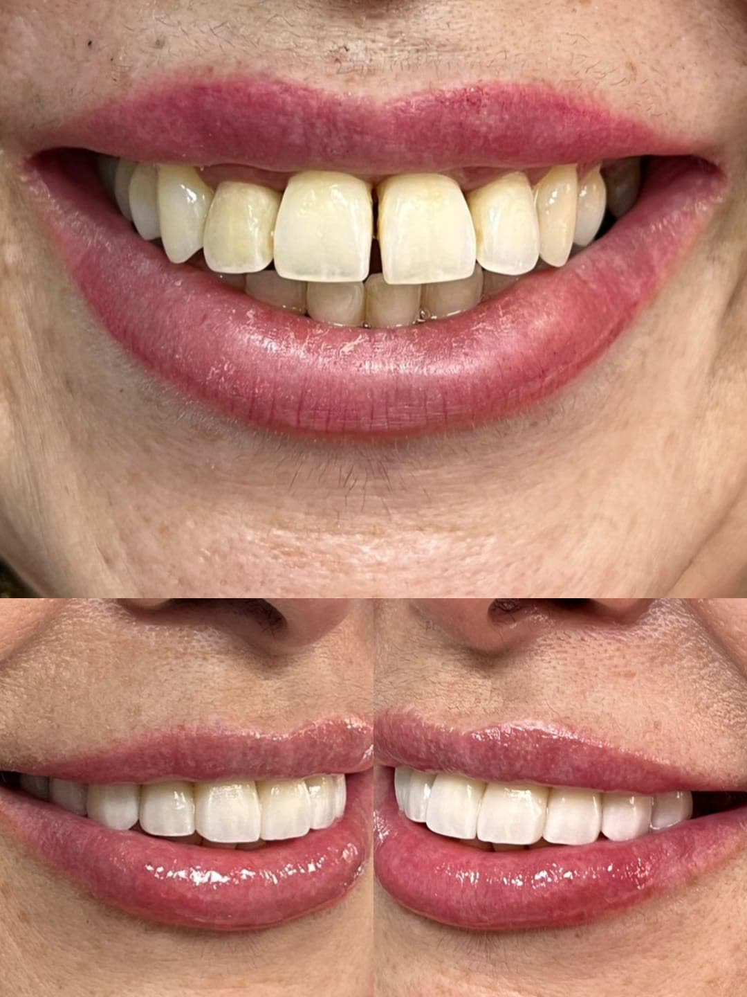 Antes y después: espacios y color corregidos con carillas de porcelana
