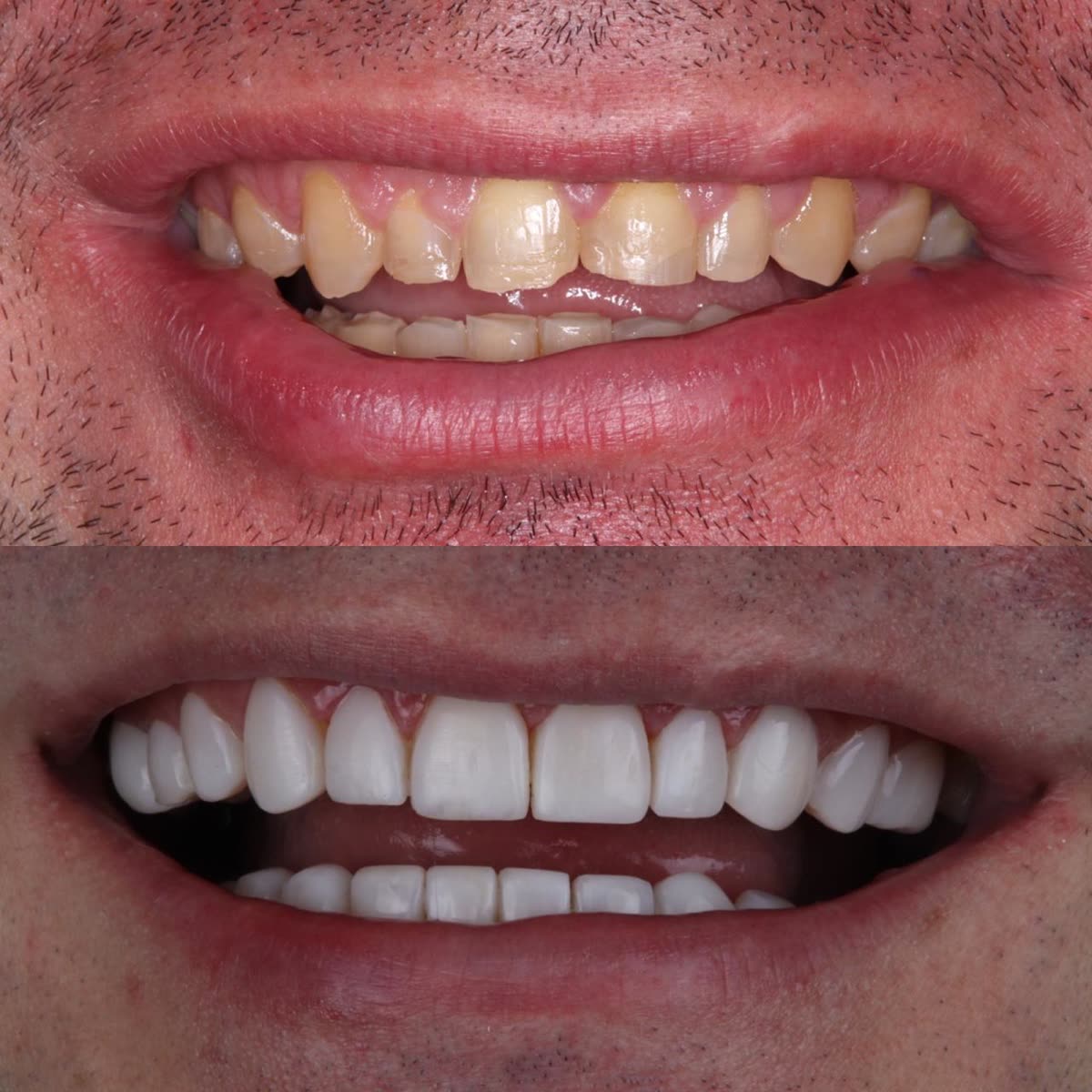 Antes y después: sonrisa renovada con carillas e.max