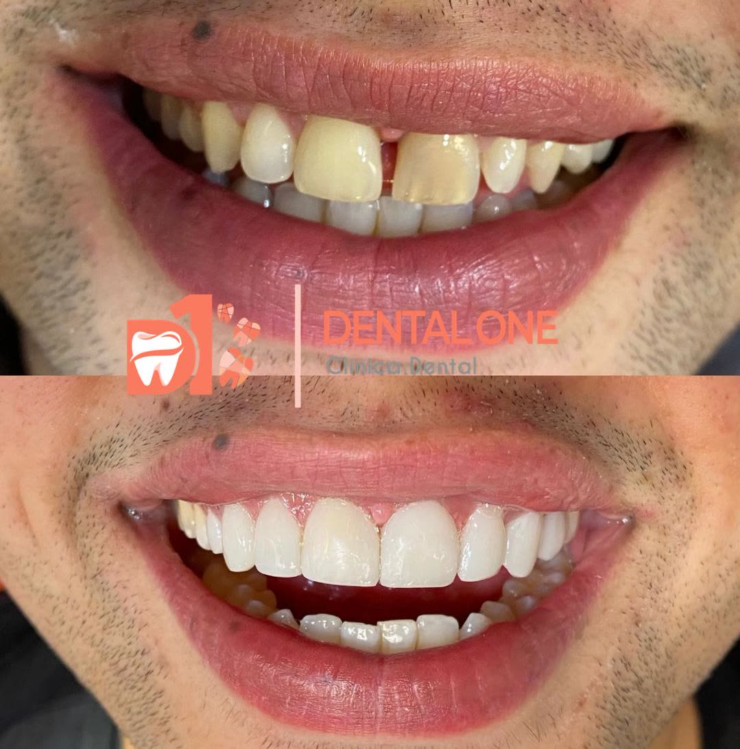 Antes y después: espacio entre los dientes delanteros cerrado con carillas