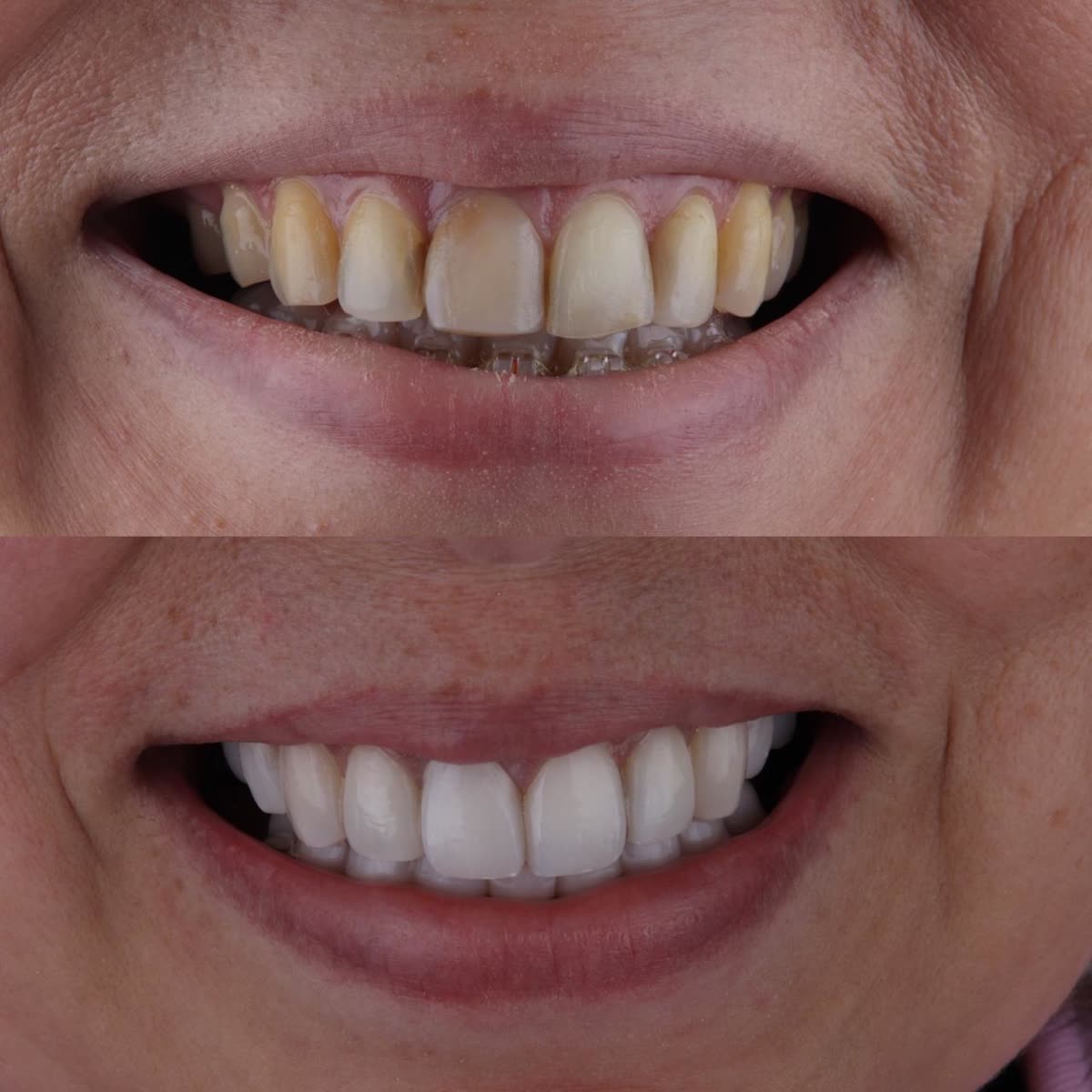 Antes y después: cambio de color con carillas