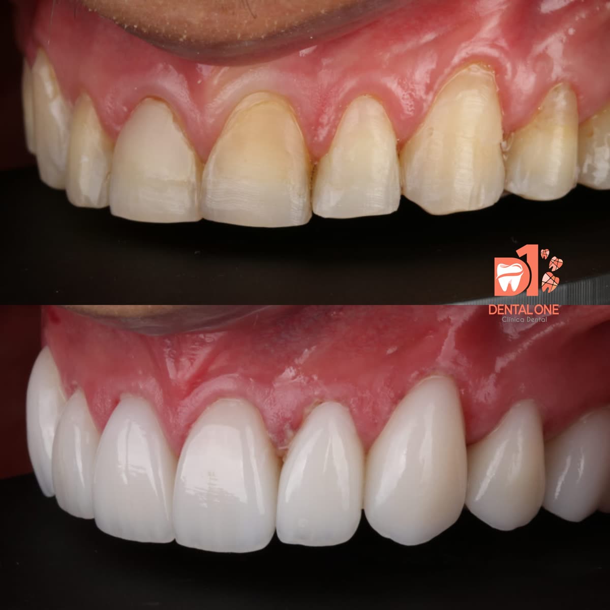 Antes y después: dientes superiores renovados con carillas e.max