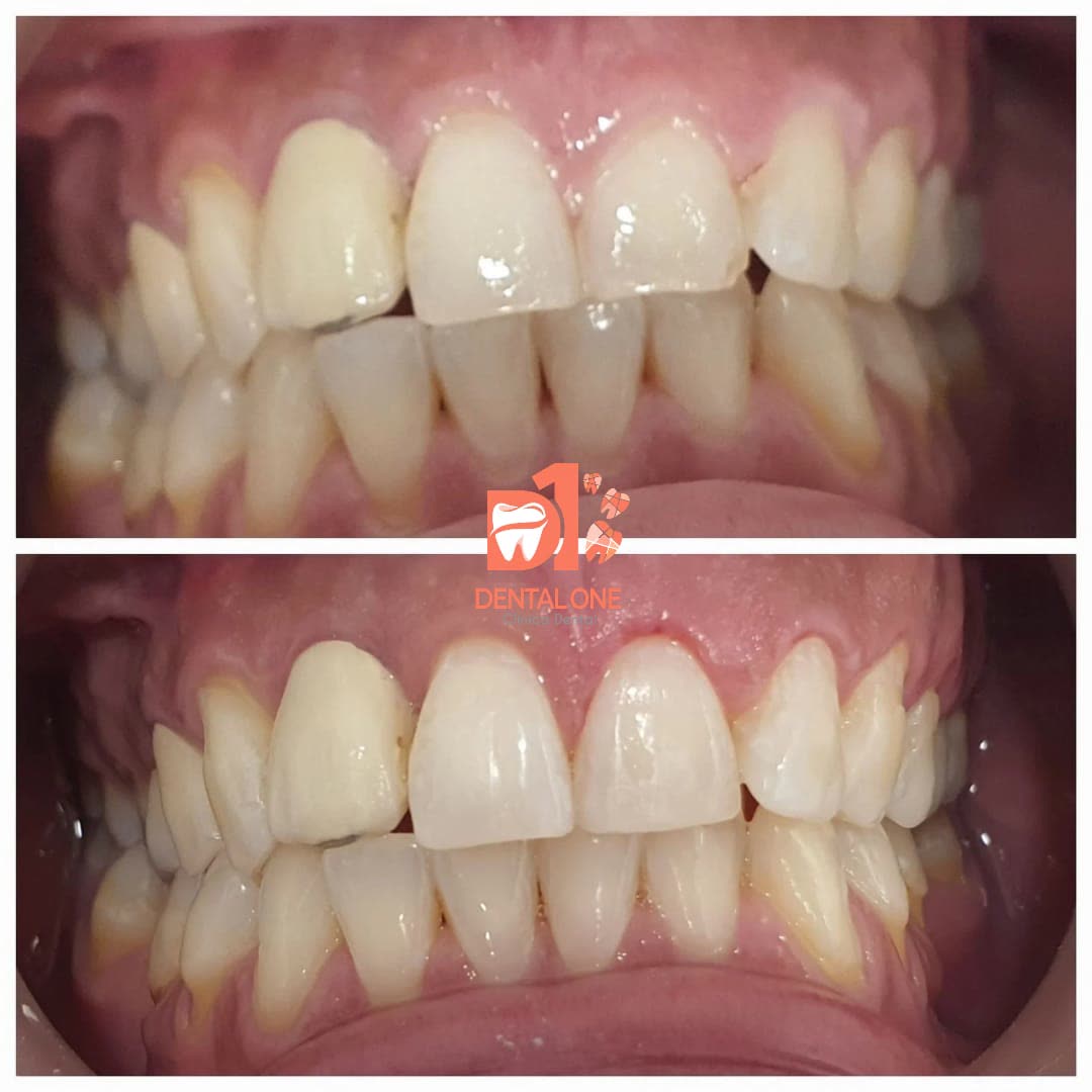 Antes y después de un microdiseño: la encía deja de tapar los dientes