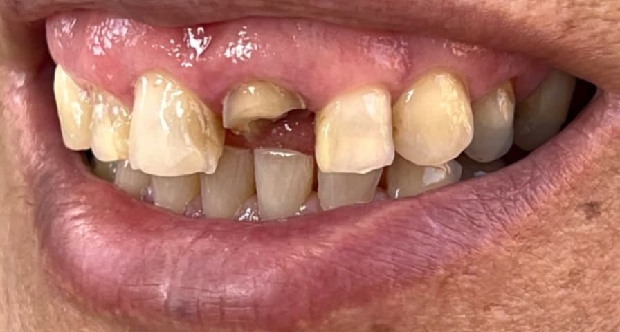 La misma sonrisa antes del tratamiento, con dientes rotos, desgastados y manchados