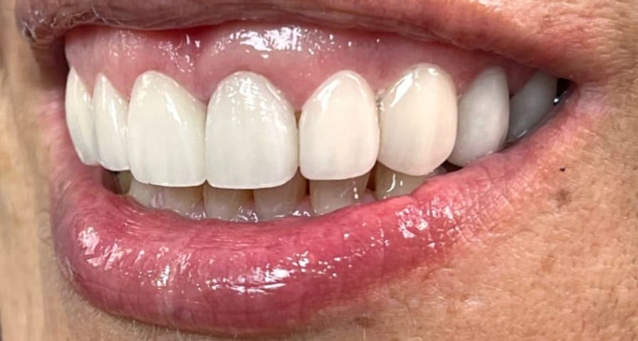 Sonrisa después de colocar carillas de porcelana: dientes blancos, completos y uniformes
